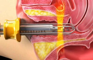 Лазерна терапія